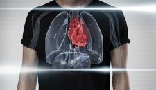 Dấu hiệu tràn dịch màng ngoài tim