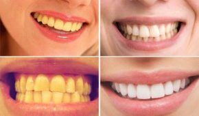 Đánh bay những vết ố vàng trên răng nhờ 1 củ nghệ